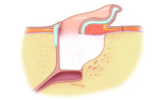 In canal wall down surgery, which exteriorizes the mastoid cavity, creation of an adequate meatus is an essential component of the procedure. The illustration depicts an unmodified meatus in relation to a canal wall down cavity. The natural meatus will not afford sufficient exposure for cleaning and will tend to foster moisture accumulation. The art of reliable meatoplasty is technically quite straightforward, but is often insufficiently taught during training. Using proper techniques, the surgeon should be able to create the desired size of meatus in a high percentage of cases.