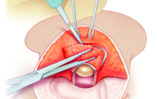 To give tension to its posterior aspect of the now enlarged meatus, the surgeon’s middle finger is placed through the meatus. Two double-pronged skin hooks elevate and stabilize the postauricular tissues. With electrocautery or scissors, the tissue is further thinned.