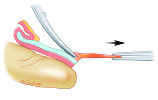 Schematic view of the perichondrial dissection from the undersurface of the concha.