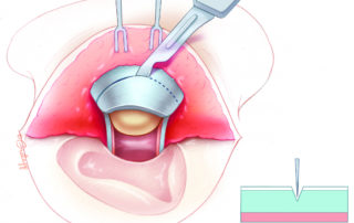 In a larger cavity, a greater extent of cartilage is excised. Note the scalpel incision is partial thickness. Scissors easily complete the rest of the cartilage transection and are less likely than a knife to perforate the underlying perichondrial leaf.