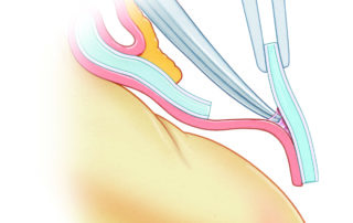 Schematic of the dissection of the cartilage off the underlying perichondrium.