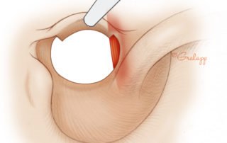 The lower aspect of the temporalis muscle often impinges on the superior aspect of the enlarged meatus.