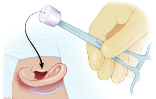 Packing is used to co-apt the meatal skin flap with the newly reshaped conchal margin. Depicted is a 0.5-inch antibiotic-impregnated strip of packing gauze wound around a clamp. While this so-called meatal roll works well, other methods such as a large Merocel sponge are also effective.