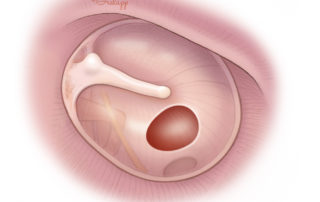 The “butterfly” technique is most suitable for small- and medium-size posterior or central perforations.