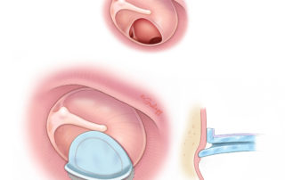 In case of marginal perforation where there is no tympanic membrane remnant, the medial wing of the butterfly cartilage graft is placed inside the annular sulcus.