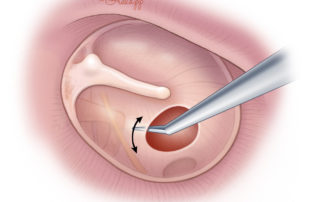 In preparation, disrupting the mucosa on the medial surface of the tympanic membrane.