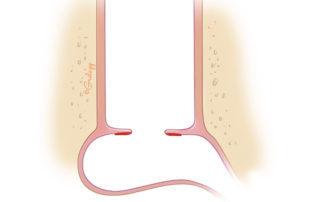 Disrupting the mucosa on the medial surface of the tympanic membrane to encourage vascular ingrowth.