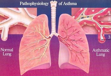 Asthma disease -bronchial asthma - Ourhealth.site image.