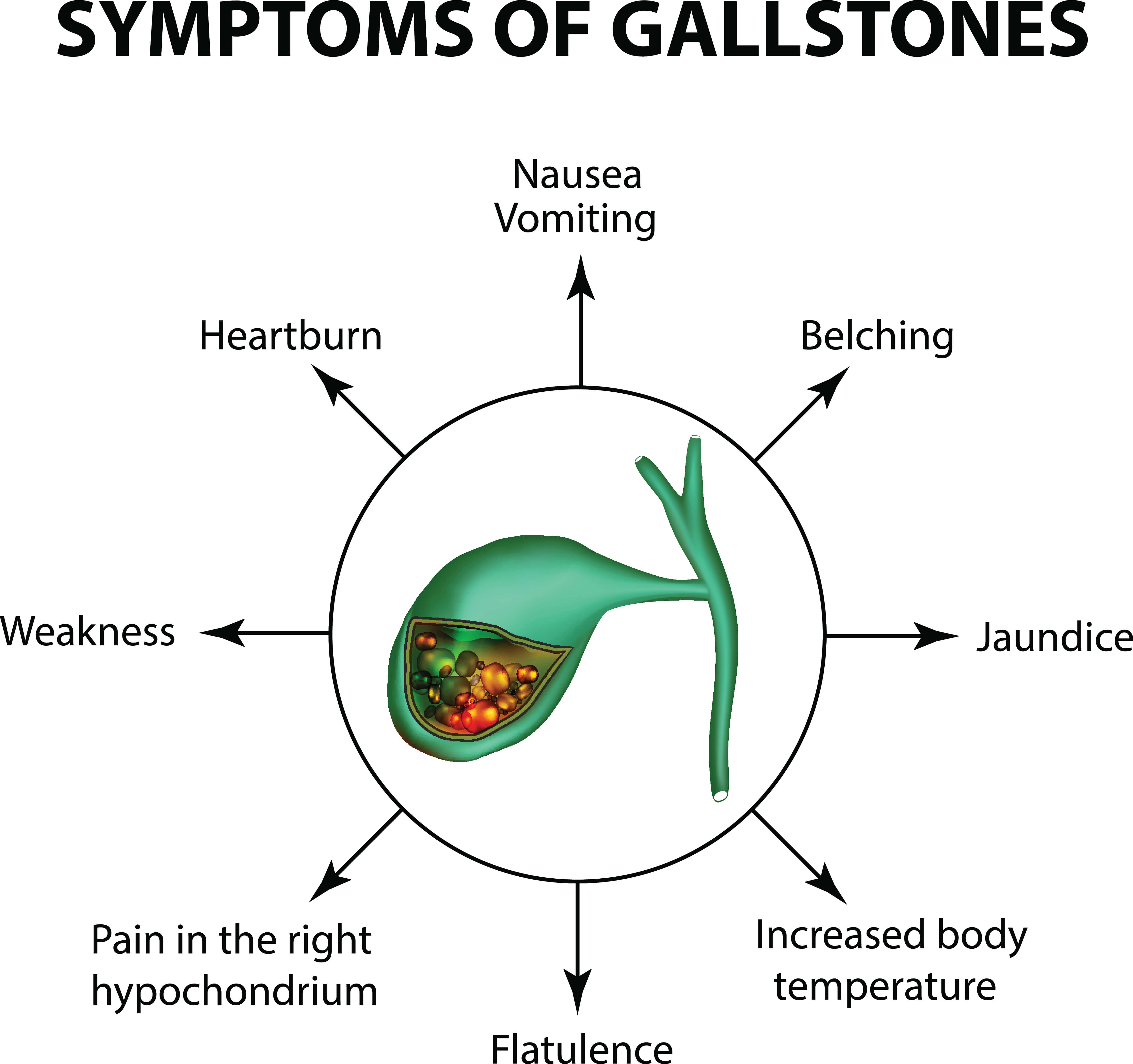 Symptoms of Gallstones