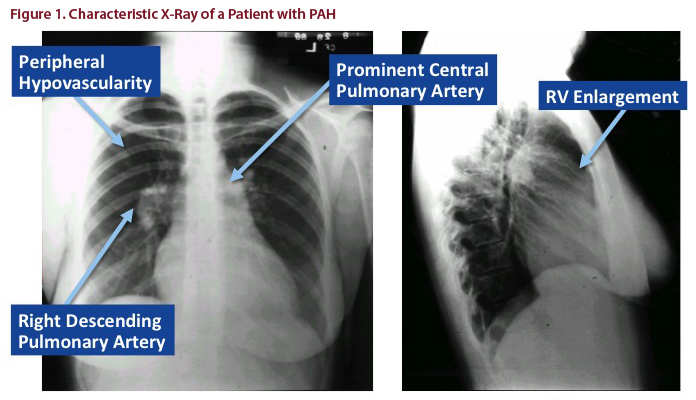 Loss Of Lung Markings Chest X Ray Medschool - vrogue.co