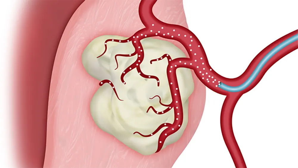 Myomectomy vs Hysterectomy: Treatment Options for Uterine Fibroids ...