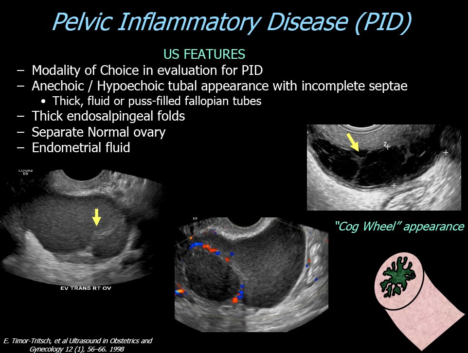 Pelvic Inflammatory Disease Ultrasound