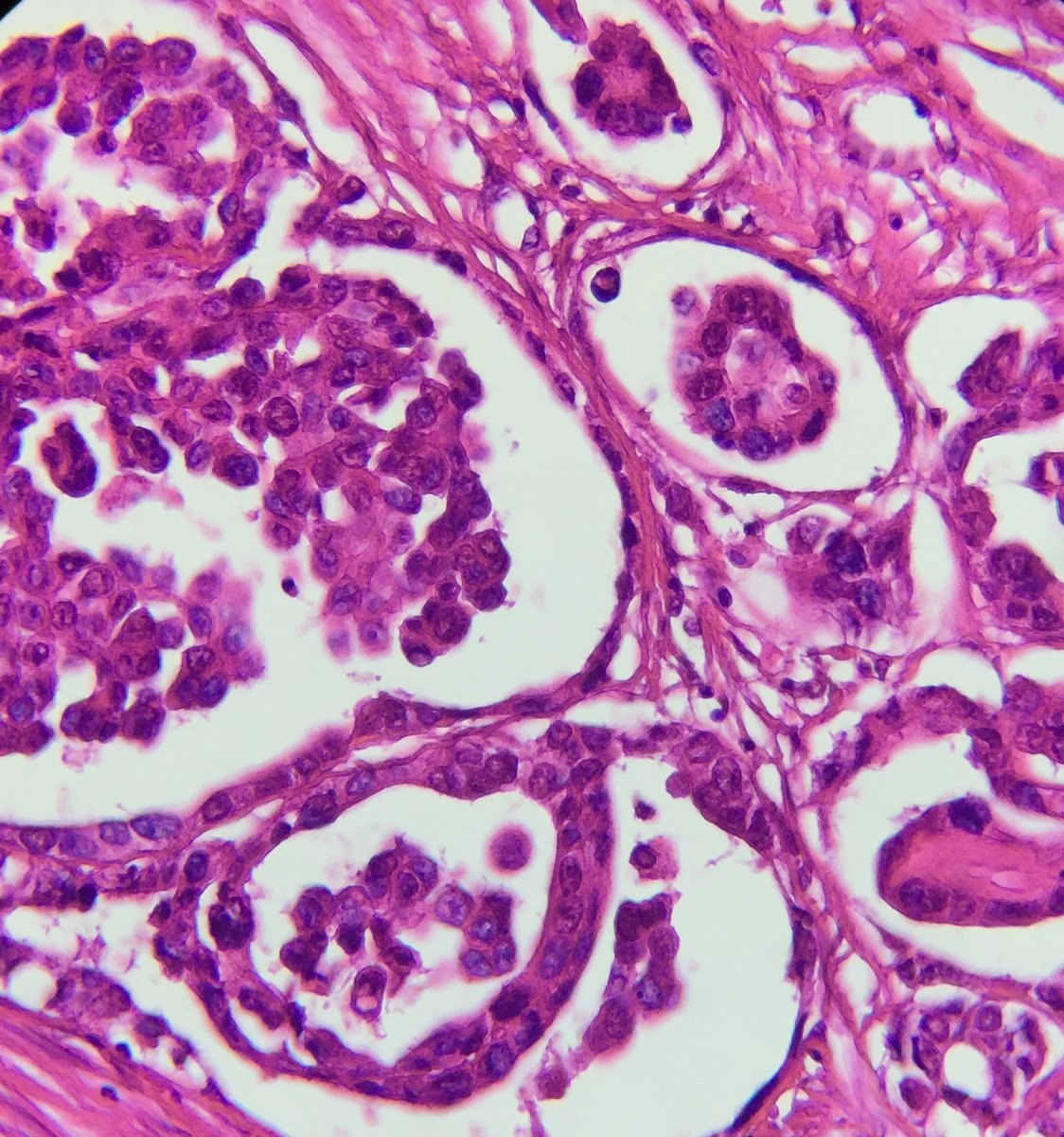 Bloody Pleural Effusion Fluid