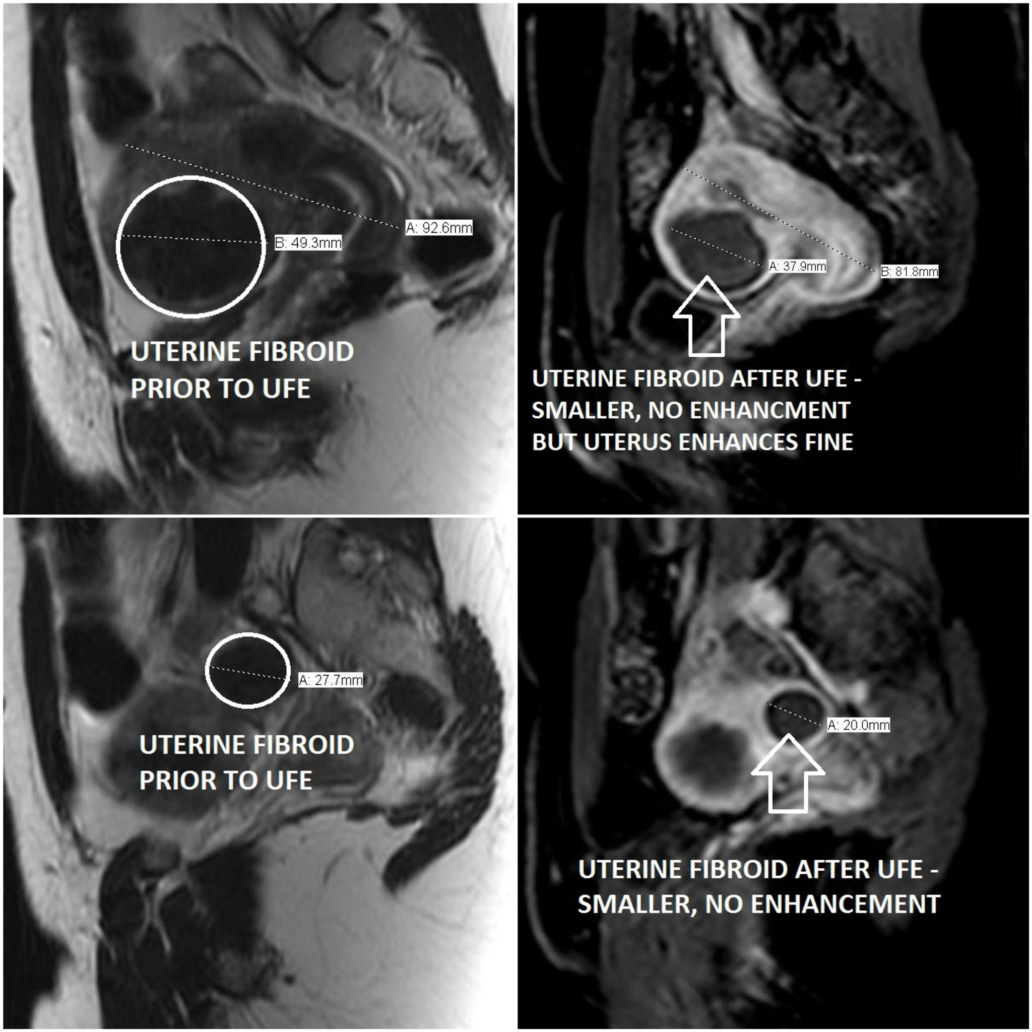 Frontiers Ultrasound-guided HIFU For Uterine Fibroids Of, 50% OFF