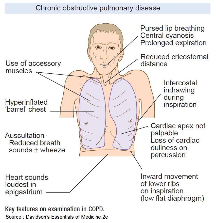 Clinical Features Of Copd Ppt Download For Pc - PELAJARAN