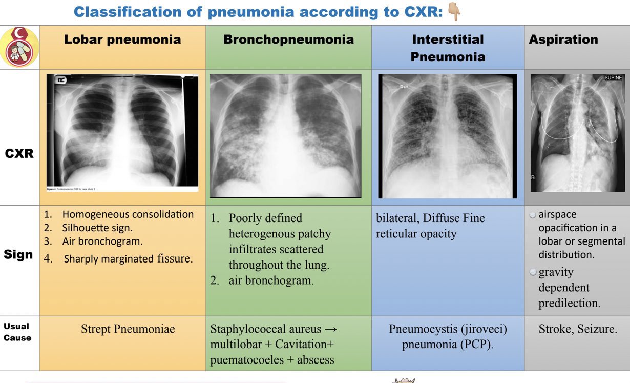 Lobar Pneumonia Vs Bronchopneumonia