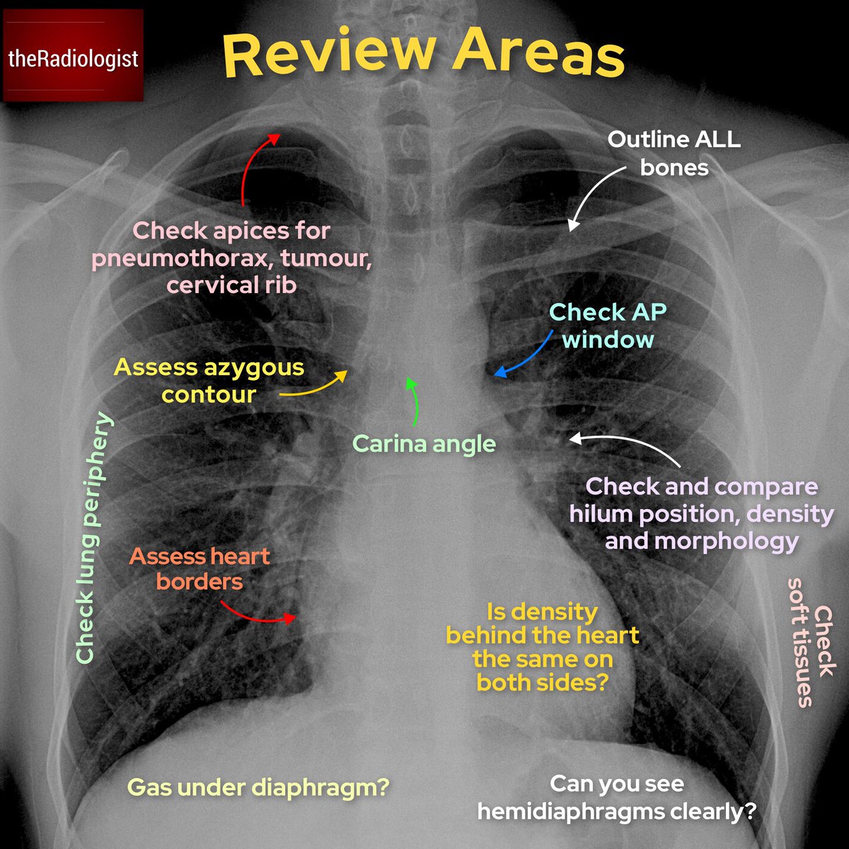 Normal Chest X Ray Labeled