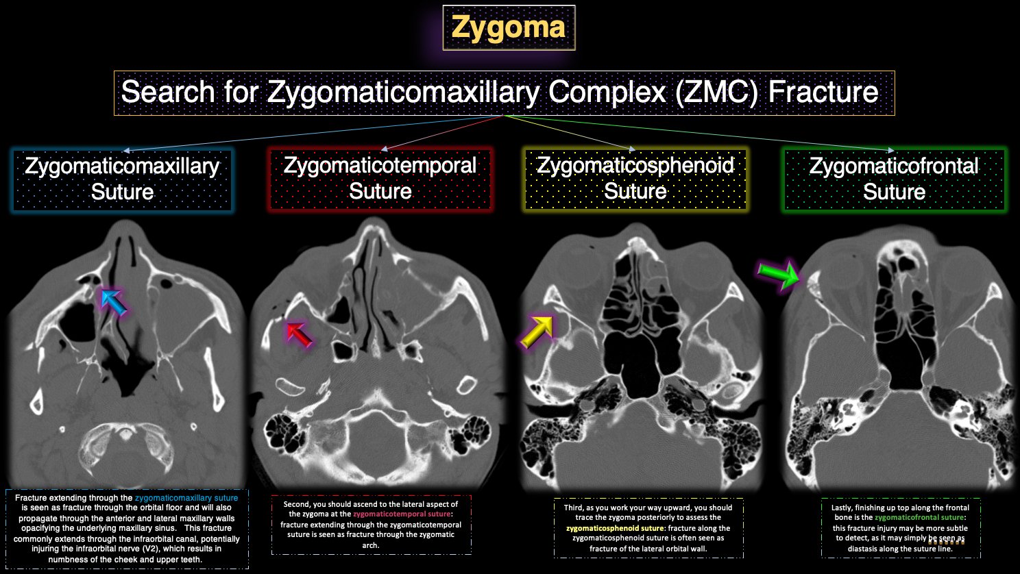 Zygomaticomaxillary Suture