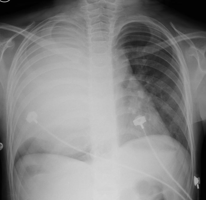 New Case! 🧵🧵 F7 paroxysmal nocturnal cough associated with wheezing ...