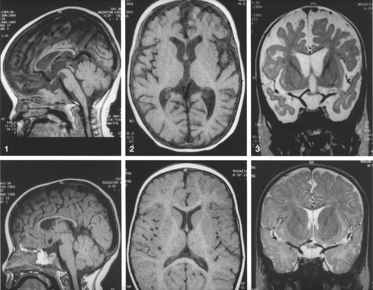 Brain atrophy in a child with vitamin B12 deficiency and its reversal ...