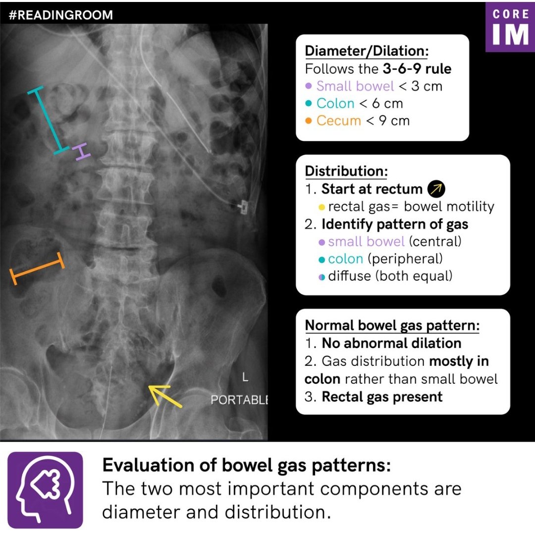 Paralytic Ileus