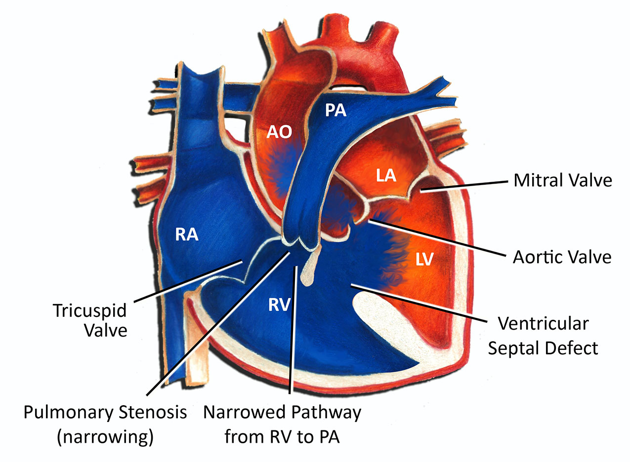 Tetralogy of Fallot - Pediatric Heart Specialists