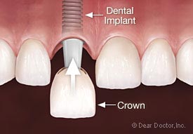 How And Why Is Bone Lost When Teeth Are Lost? | Pembroke Dental