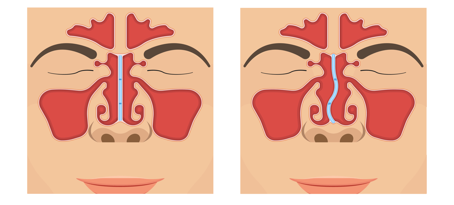 Deviated Septum Diagram