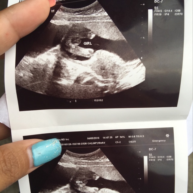 Baby girl ultrasound photos - Glow Community