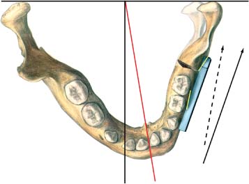 Intraoral Distraction Osteogenesis of the Mandible and the Maxilla ...