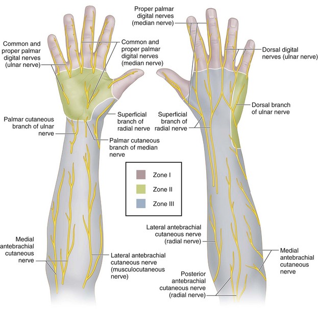 17: Surgical Treatment of Neuromas in the Hand | Plastic Surgery Key