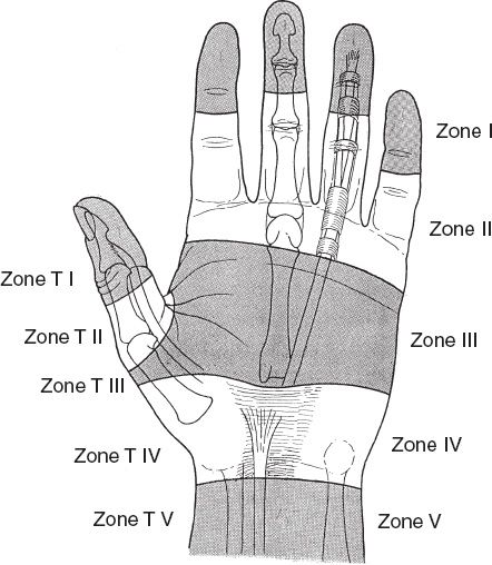 Tendon Injuries and Tendonitis | Plastic Surgery Key