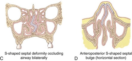 20: Nasal Fractures: Evaluation And Management 