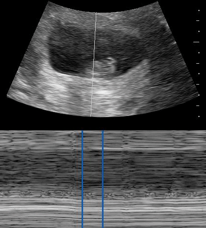 Fetal Heart Rate Ultrasound Images : Unfortunately, an abnormal fetal ...