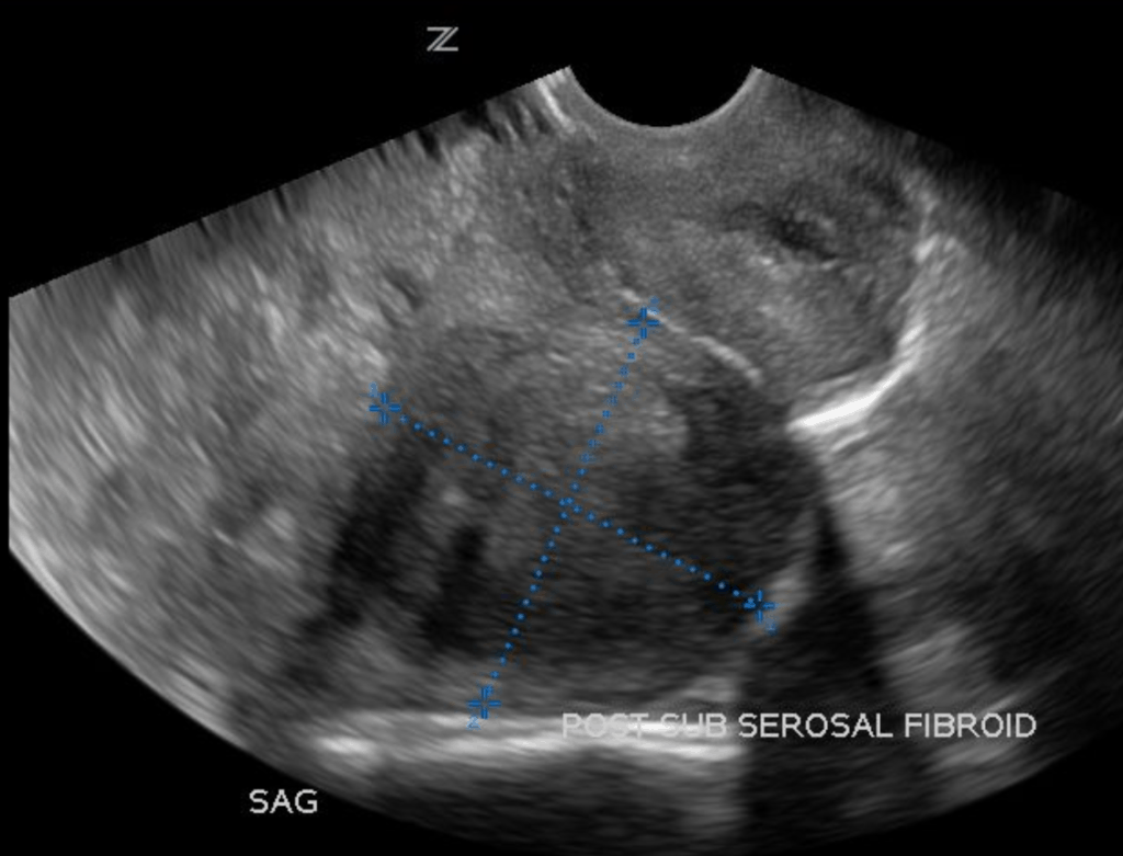 5. Uterine Ultrasound Pathology – My Blog