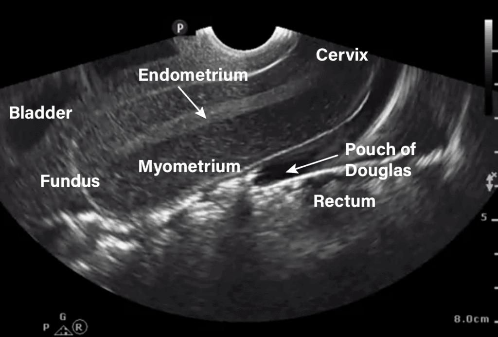 Intrauterine Ultrasound