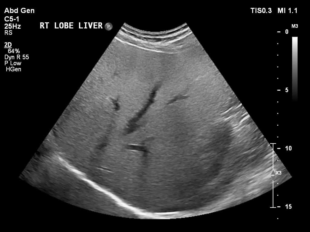 Normal Vs Fatty Liver Ultrasound