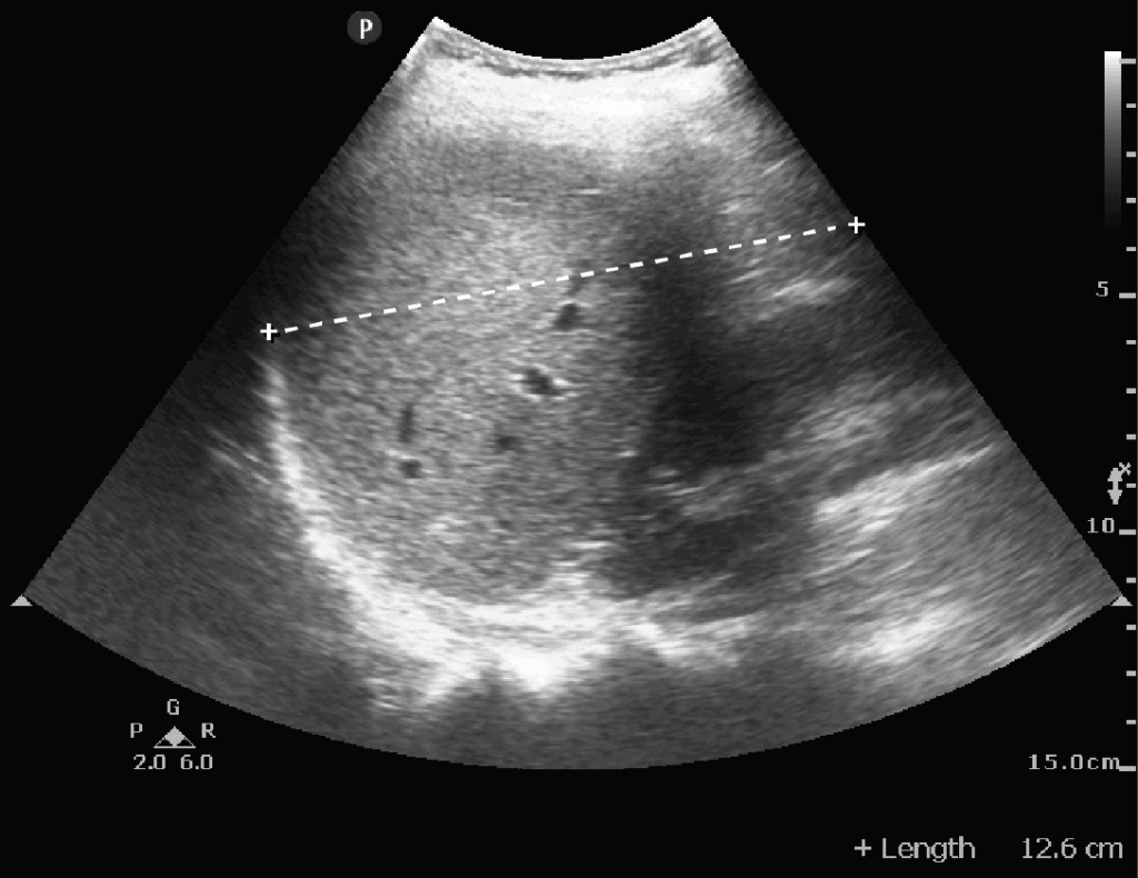 Normal Vs Fatty Liver Ultrasound