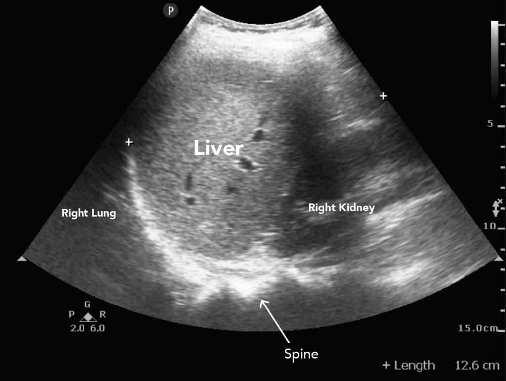 Liver Ultrasound Anatomy