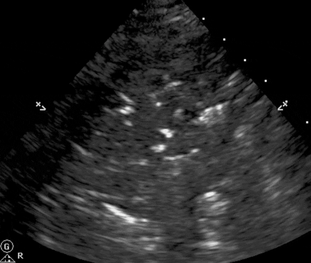 Lung Ultrasound Made Easy: Step-By-Step Guide – PoCUS Academy