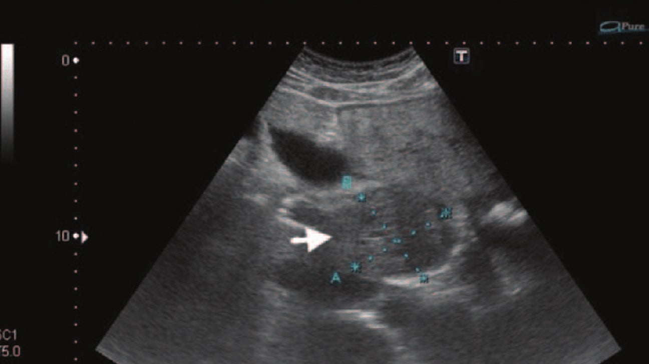 Liver Cancer Ultrasound