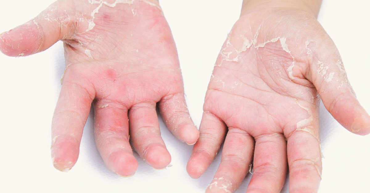 Palmoplantar psoriasis: Causes, symptoms, and treatment