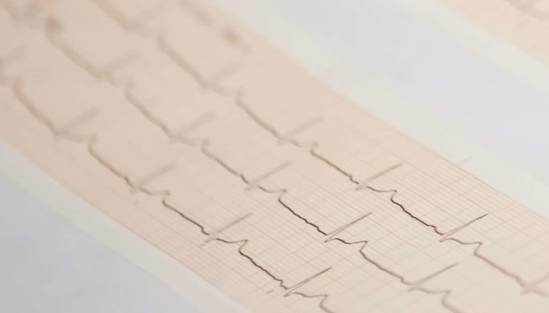 Abnormal EKG: Results, causes, and treatment