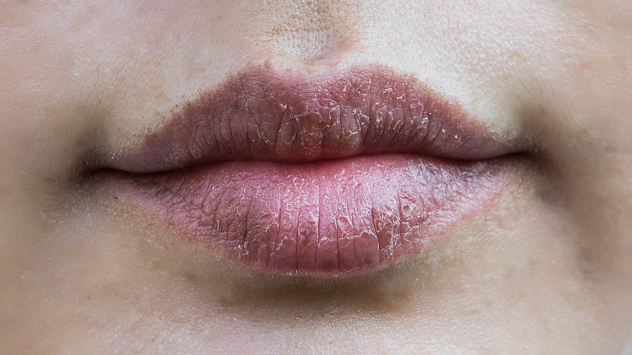 Cluster Of Bumps Near Lip