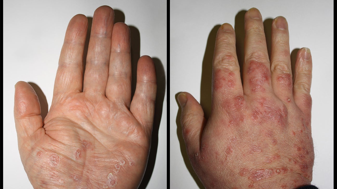 Psoriasis Wrist