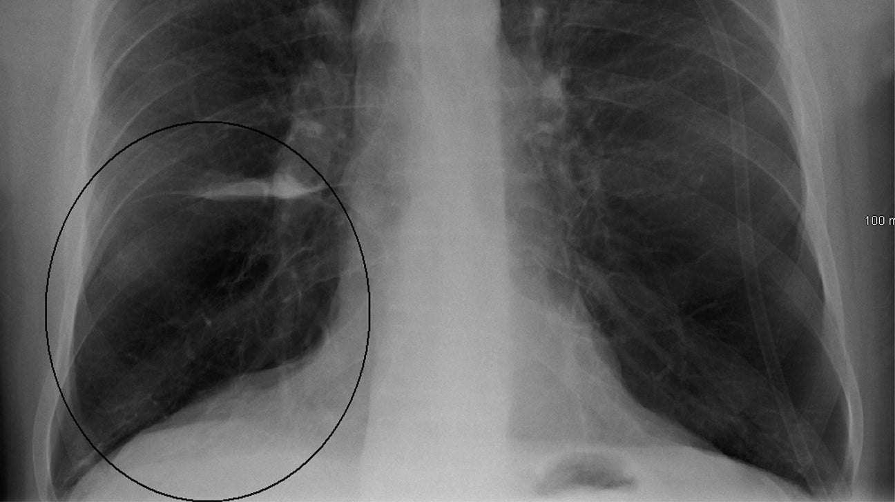 Emphysema Chest X Ray