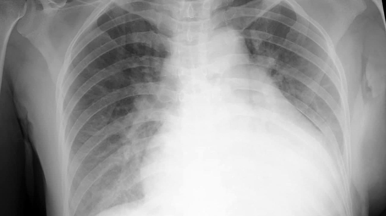 Pulmonary Edema Chf Chest X Ray