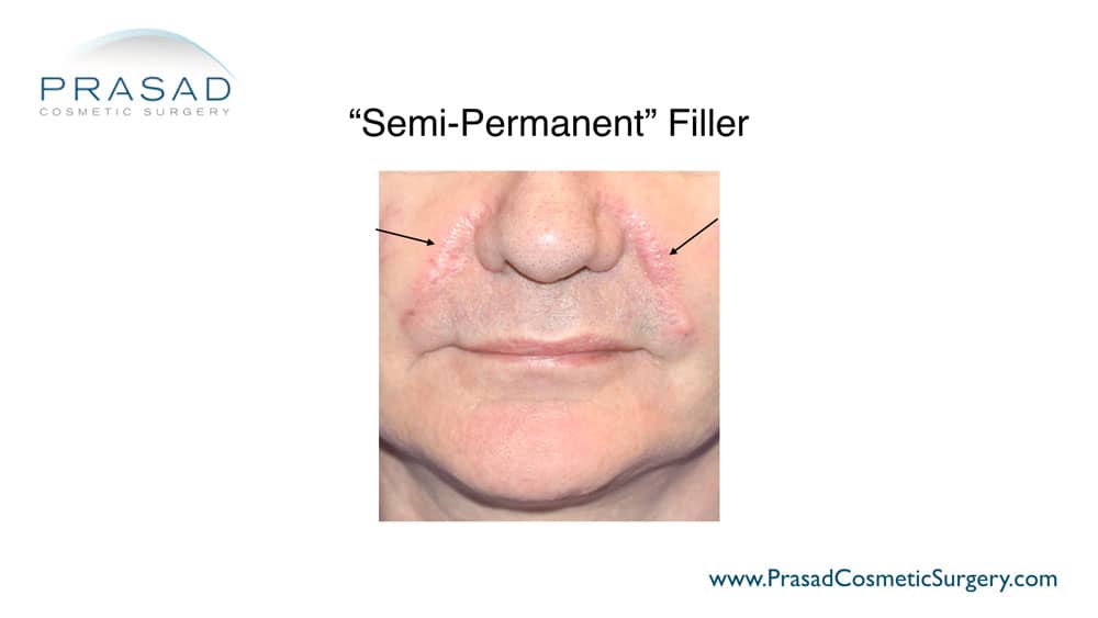 semi-permanent fillers example