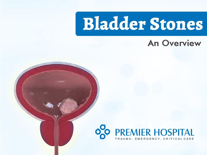 Bladder Stones An Overview