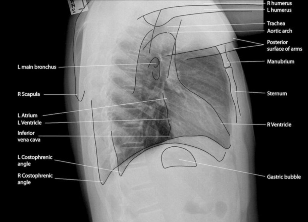 Normal Chest X Ray Labeled